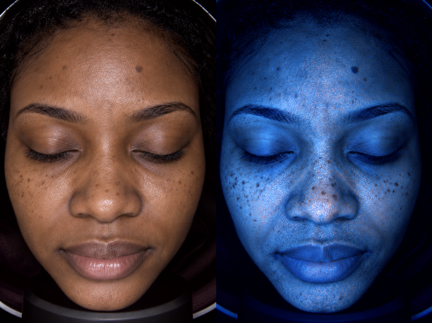 Illustration d'analyse cutanée comparant lumière naturelle et lumière bleue